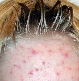 acne on forehead