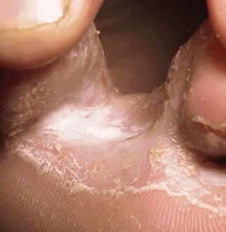 tinea pedis between toes