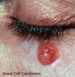 basal cell carcinoma