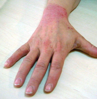 eczema on hand