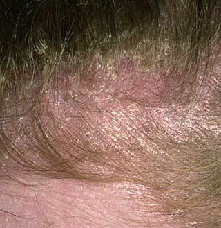 seborrheic dermatitis