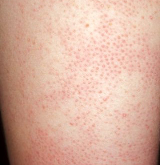 keratosis pilaris