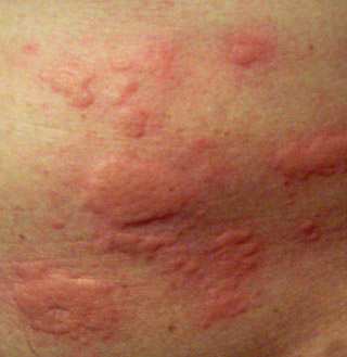 skin rash closeup