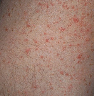 skin rash