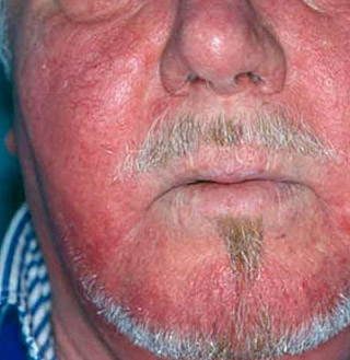 facial rosacea