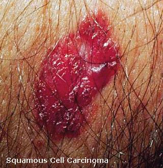 squamous cell carcinoma