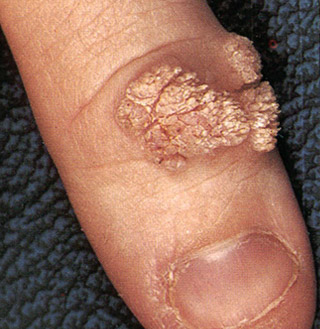 wart closeup